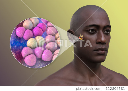 Otitis media ear infection, 3D illustration Otitis media ear infection, 3D illustration 112804581