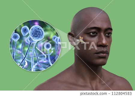 Mucormycosis of the middle ear, 3D illustration 112804583