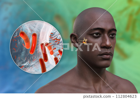Otitis media ear infection, 3D illustration Otitis media ear infection, 3D illustration 112804623