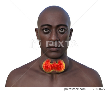 A man with enlarged thyroid gland, 3D illustration A man with enlarged thyroid gland, 3D illustration 112804627