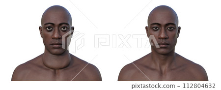 A man with enlarged thyroid gland, 3D illustration A man with enlarged thyroid gland, 3D illustration 112804632
