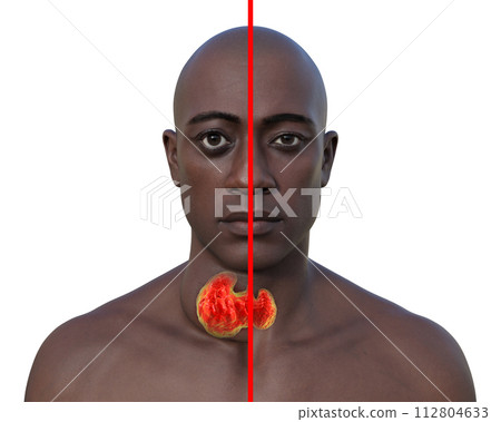 A man with enlarged thyroid gland, 3D illustration A man with enlarged thyroid gland, 3D illustration 112804633