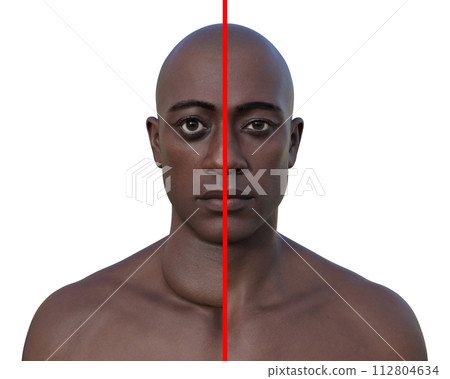 A man with enlarged thyroid gland, 3D illustration A man with enlarged thyroid gland, 3D illustration 112804634