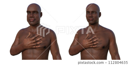 Acromegaly in a man, and the same healthy person, 3D illustration 112804635
