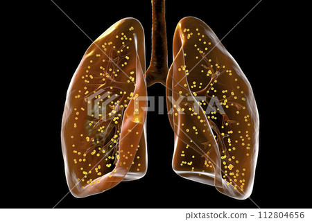 Human lungs affected by miliary tuberculosis, 3D illustration 112804656