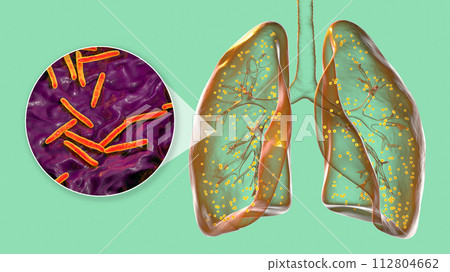 Human lungs affected by miliary tuberculosis, and close-up view of Mycobacterium tuberculosis, 3D illustration 112804662