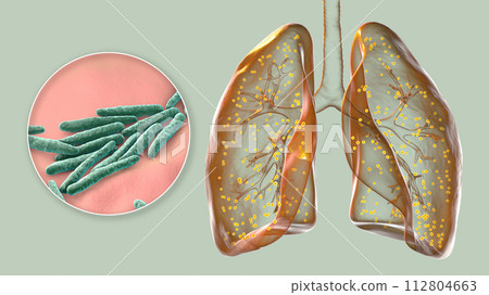 Human lungs affected by miliary tuberculosis, and close-up view of Mycobacterium tuberculosis, 3D illustration 112804663