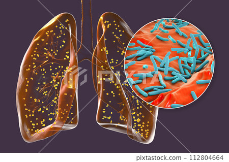 Human lungs affected by miliary tuberculosis, and close-up view of Mycobacterium tuberculosis, 3D illustration 112804664