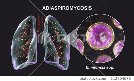 Lung adiaspiromycosis and close-up view of Emmonsia fungi, 3D illustration Lung adiaspiromycosis and close-up view of Emmonsia fungi, 3D illustration 112804670