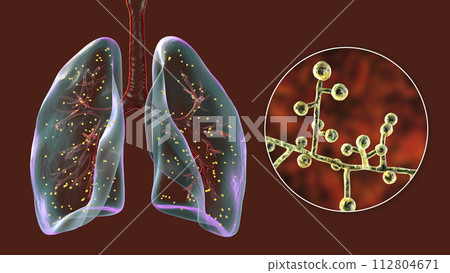 Lung adiaspiromycosis and close-up view of Emmonsia fungi, 3D illustration Lung adiaspiromycosis and close-up view of Emmonsia fungi, 3D illustration 112804671