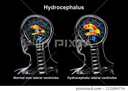 Enlarged and normal lateral ventricles, 3D illustration Enlarged and normal lateral ventricles, 3D illustration 112804734