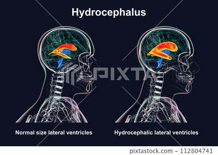 Enlarged and normal lateral ventricles, 3D illustration 112804741