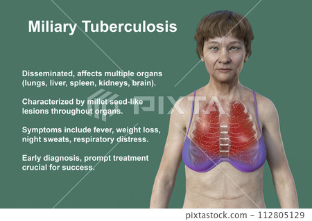 A female patient with lungs affected by miliary tuberculosis, 3D illustration 112805129