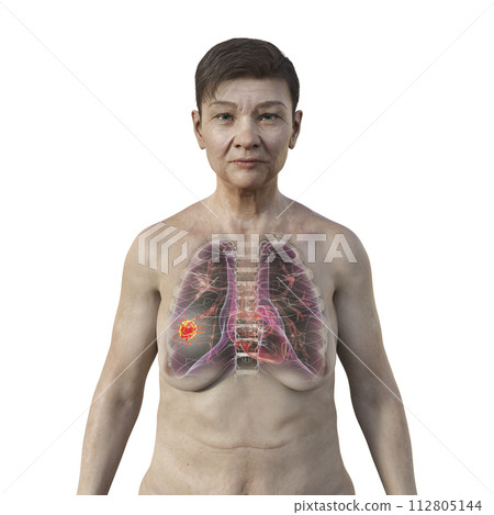 A 3D illustration of a woman with transparent skin, revealing the presence of lung cancer. 112805144