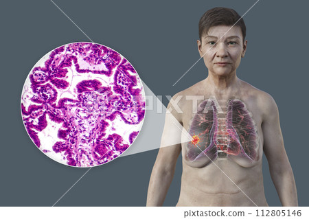 A woman with lung cancer, 3D illustration, and photomicrograph of lung adenocarcinoma 112805146
