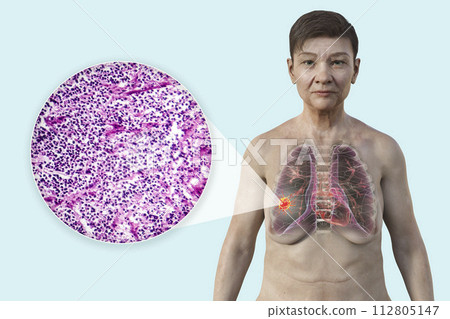A woman with lung cancer, 3D illustration, and photomicrograph of small cell lung cancer 112805147