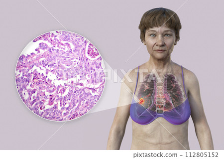 A woman with lung cancer, 3D illustration, and photomicrograph of lung cancer tissue A woman with lung cancer, 3D illustration, and photomicrograph of lung cancer tissue 112805152