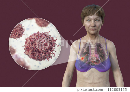 A woman with lung cancer, and close-up view of cancer cells, 3D illustration A woman with lung cancer, and close-up view of cancer cells, 3D illustration 112805155