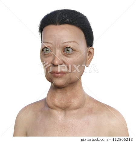 A woman with Graves' disease, 3D illustration A woman with Graves' disease, 3D illustration 112806218