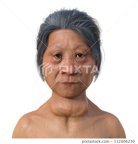 A woman with Graves' disease, 3D illustration A woman with Graves' disease, 3D illustration 112806230