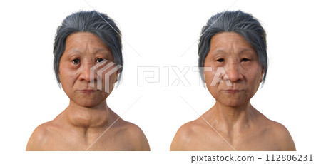A woman with Graves' disease and the same healthy person, 3D illustration A woman with Graves' disease and the same healthy person, 3D illustration 112806231