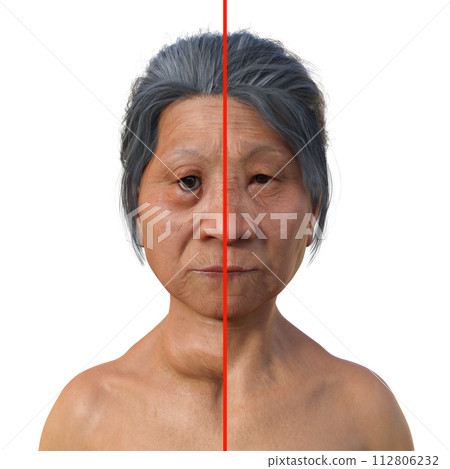 A woman with Graves' disease and the same healthy person, 3D illustration A woman with Graves' disease and the same healthy person, 3D illustration 112806232