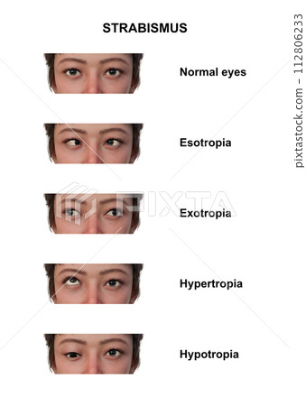 A woman with various strabismus types, 3D illustration A woman with various strabismus types, 3D illustration 112806233