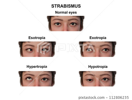A woman with various strabismus types, 3D illustration 112806235