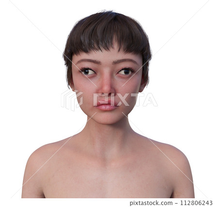 A woman with exotropia, 3D illustration A woman with exotropia, 3D illustration 112806243