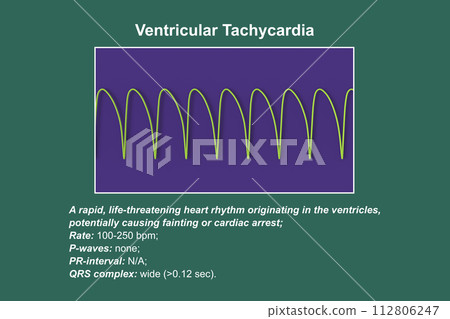 ECG in ventricular tachycardia, 3D illustration. 112806247