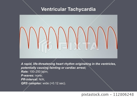 ECG in ventricular tachycardia, 3D illustration. 112806248