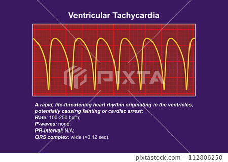 ECG in ventricular tachycardia, 3D illustration. 112806250
