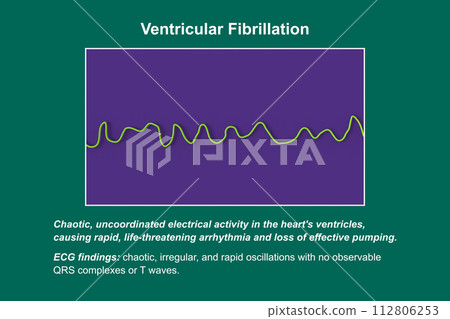 ECG displaying the chaotic rhythm of ventricular fibrillation, 3D illustration 112806253