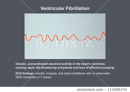 ECG displaying the chaotic rhythm of ventricular fibrillation, 3D illustration 112806254