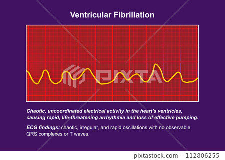 ECG displaying the chaotic rhythm of ventricular fibrillation, 3D illustration 112806255