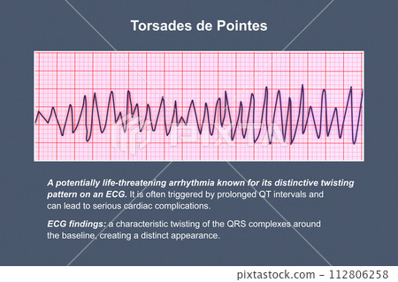 ECG displaying Torsades de pointes rhythm, 3D illustration 112806258