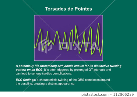 ECG displaying Torsades de pointes rhythm, 3D illustration ECG displaying Torsades de pointes rhythm, 3D illustration 112806259