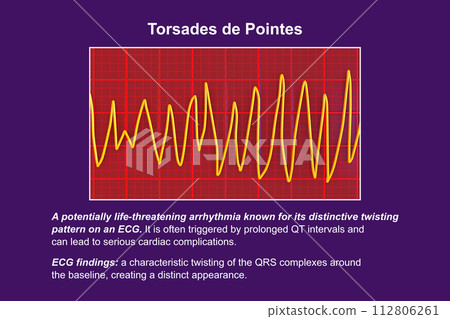 ECG displaying Torsades de pointes rhythm, 3D illustration ECG displaying Torsades de pointes rhythm, 3D illustration 112806261