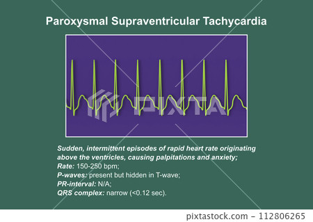 ECG in supraventricular tachycardia, 3D illustration 112806265