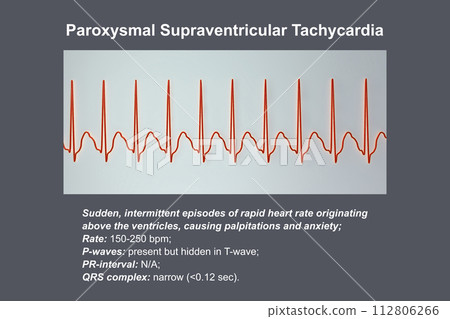 ECG in supraventricular tachycardia, 3D illustration 112806266
