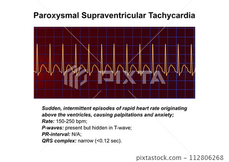 ECG in supraventricular tachycardia, 3D illustration 112806268