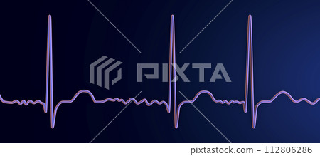 ECG in atrial fibrillation, 3D illustration ECG in atrial fibrillation, 3D illustration 112806286