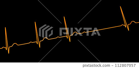 An ECG with 2nd degree AV block, 3D illustration 112807057