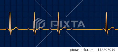 An ECG with 2nd degree AV block, 3D illustration 112807059