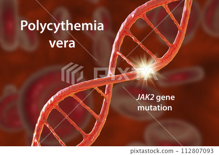 Polycythemia vera, a rare slow-growing blood cancer with an increase in the number of red blood cells 112807093