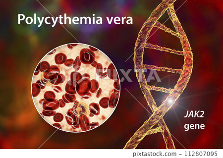 Polycythemia vera, a rare slow-growing blood cancer with an increase in the number of red blood cells 112807095