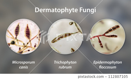 Dermatophyte fungi, 3D illustration Dermatophyte fungi, 3D illustration 112807105