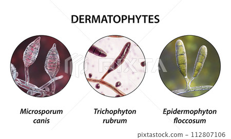 Dermatophyte fungi, 3D illustration 112807106