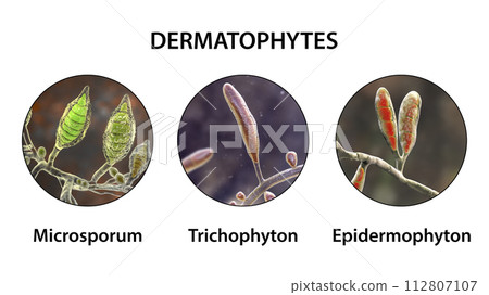 Dermatophyte fungi, 3D illustration Dermatophyte fungi, 3D illustration 112807107