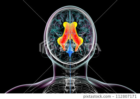 Enlarged lateral and third ventricles of the brain, 3D illustration Enlarged lateral and third ventricles of the brain, 3D illustration 112807171